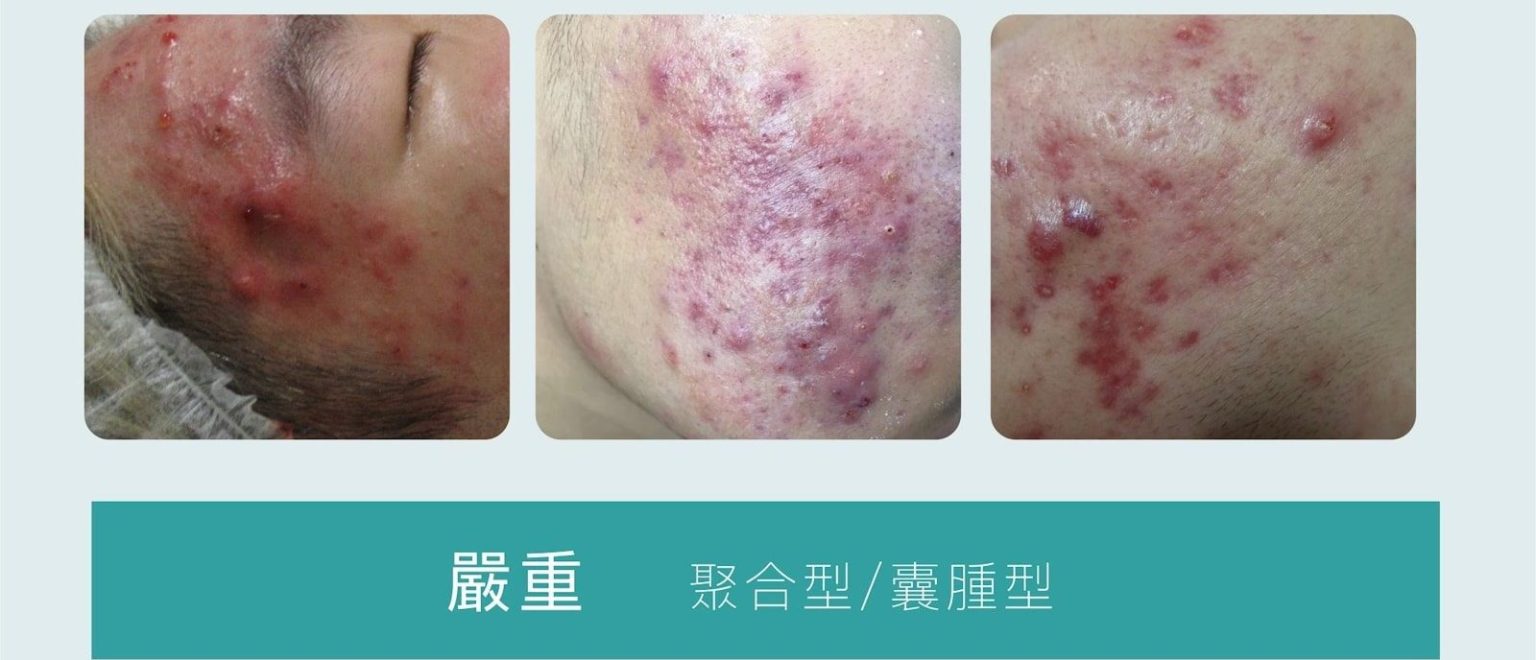 【暗瘡全攻略】剖析暗瘡種類、症狀、位置、成因、治療及預防 - GENE SKIN 柔針清痘專家