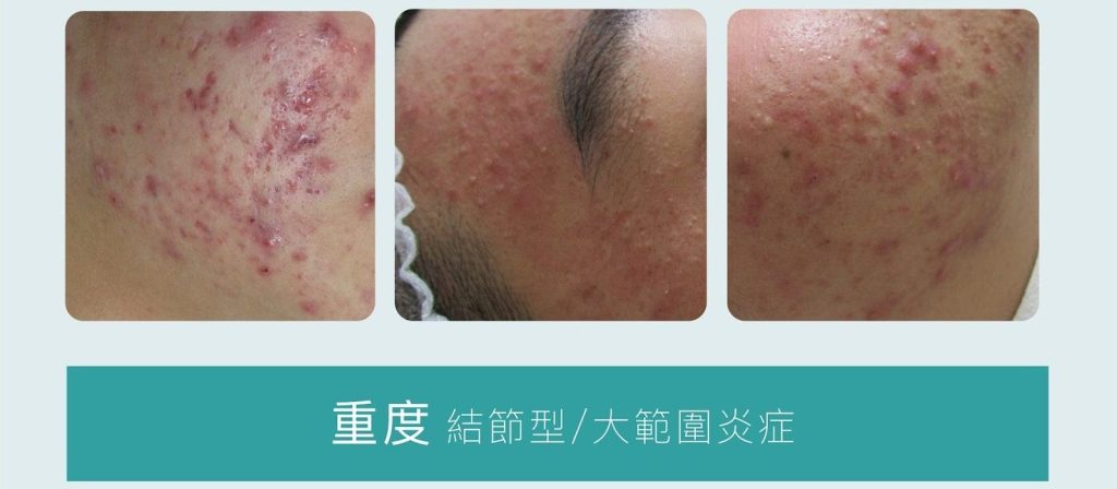 【暗瘡全攻略】剖析暗瘡種類、症狀、位置、成因、治療及預防 - GENE SKIN 柔針清痘專家