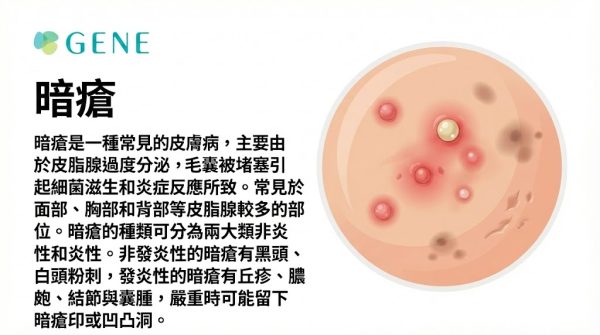 【暗瘡全攻略】剖析暗瘡種類、症狀、位置、成因、治療及預防 - GENE SKIN 柔針清痘專家