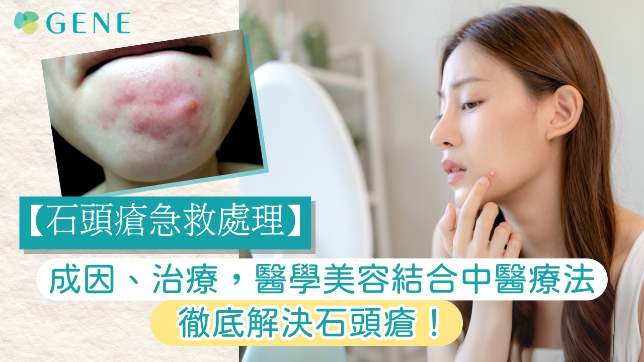 【粉刺】由種類、成因到治療,助您KO粉刺,重塑光滑肌膚!(附專業療程推介) - GENE SKIN 柔針清痘專家